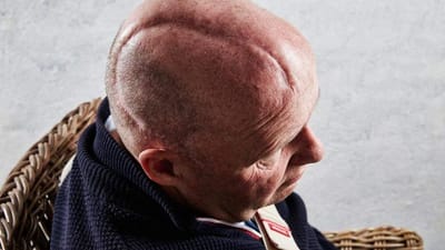 Falckredder Erik Schack sv&aelig;vede mellem liv og d&oslash;d i koma i 19 dage med familien ved sin side.