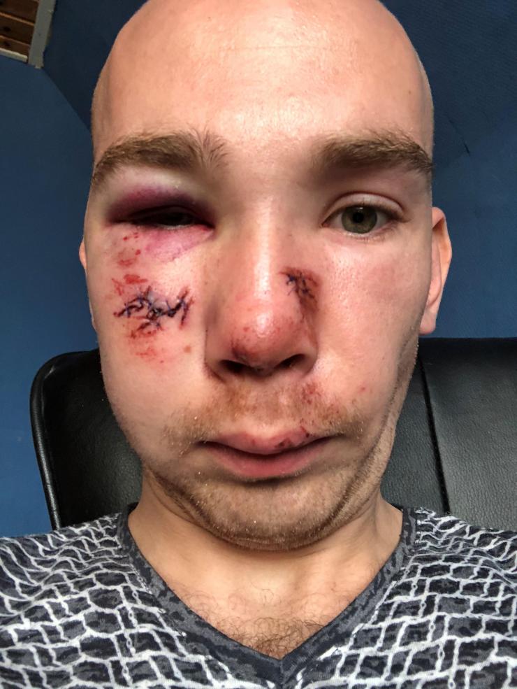 Den ukrainke landbrugspraktikant Kostiantyn Hryhorashchenko blev syet med otte sting i ansigtet efter en arbejdsulykke hos sin danske arbejdsgiver - og kort efter fyret.