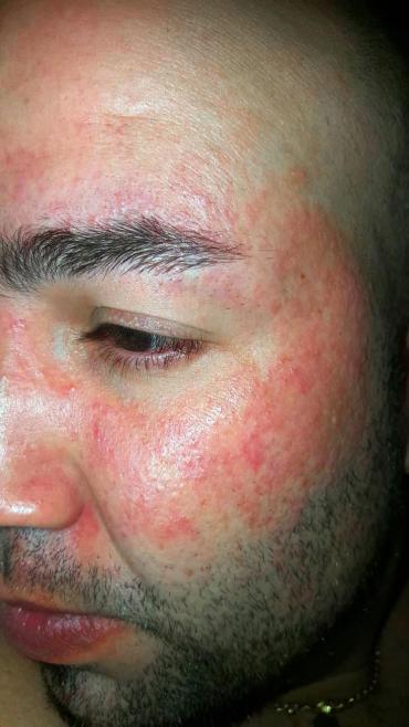 Diego Perez måtte stoppe arbejdet hos Vestas i 2017, da han fik alvorlig epoxy-allergi.