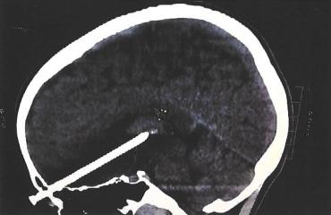 Røntgenbillede af Annicas hoved, mens sømmet stadig sidder i