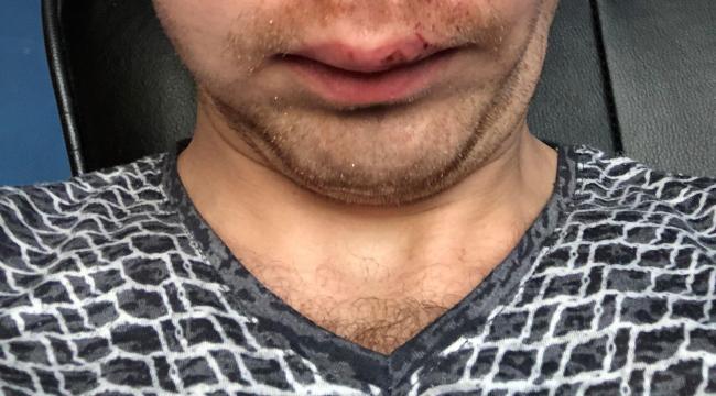 Den ukrainke landbrugspraktikant Kostiantyn Hryhorashchenko blev syet med otte sting i ansigtet efter en arbejdsulykke hos sin danske arbejdsgiver.