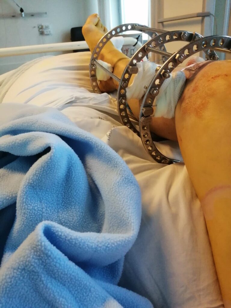 Aija Skuja er fortsat handicappet efter arbejdsulykken. 