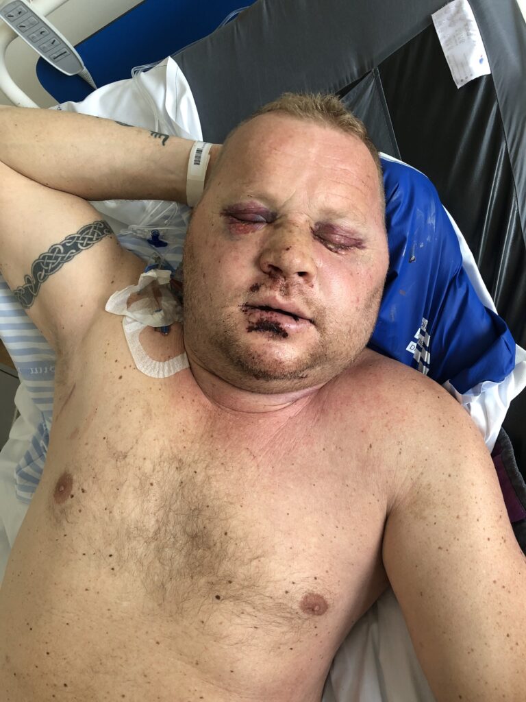 Søren Strebøl Larsen i hospitalssengen på Skejby Sygehus, efter han ikke længere var i kunstigt koma. 